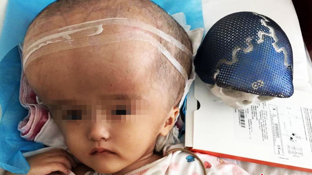 У Китаї провели першу в світі операцію по зменшенню голови - фото 1